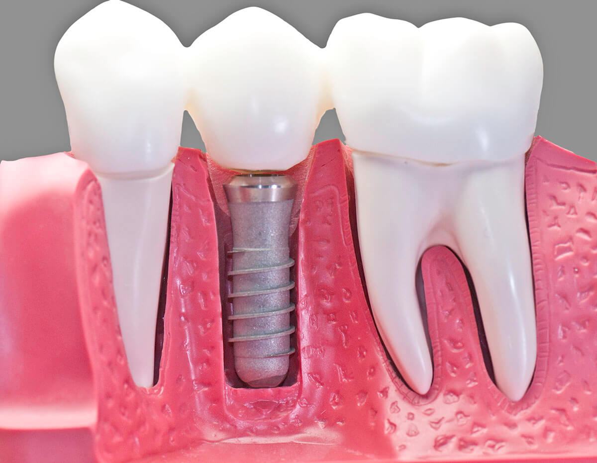 Fort Worth Dental Implants