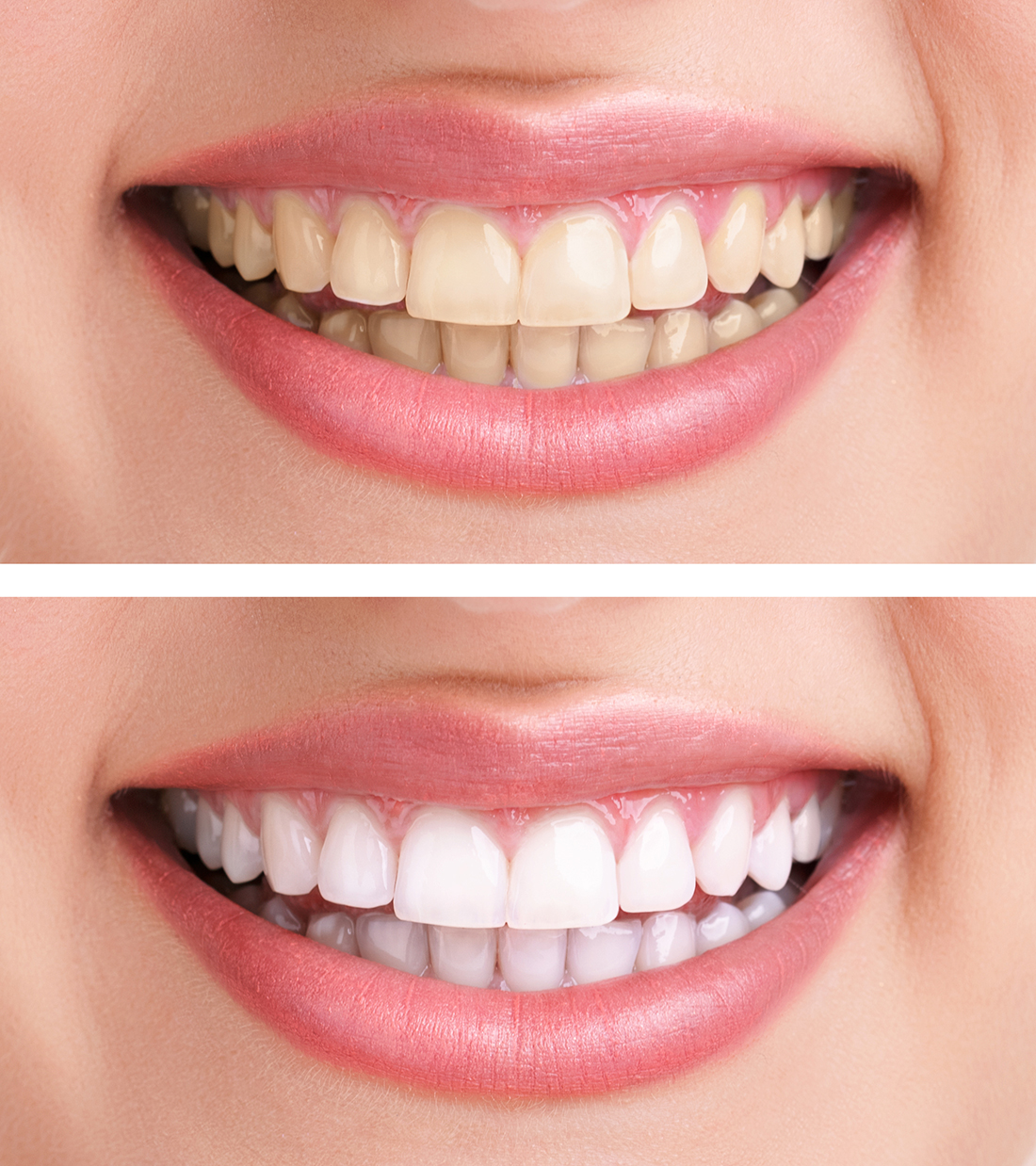 Teeth Whitening Fort Worth Texas