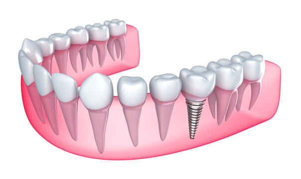 3d Model of Dental Implant