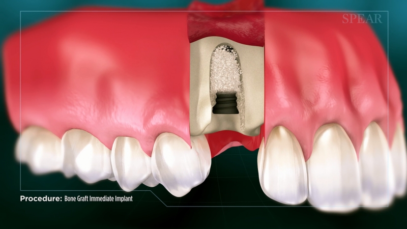 Bone Graft with Immediate Implant Placement
