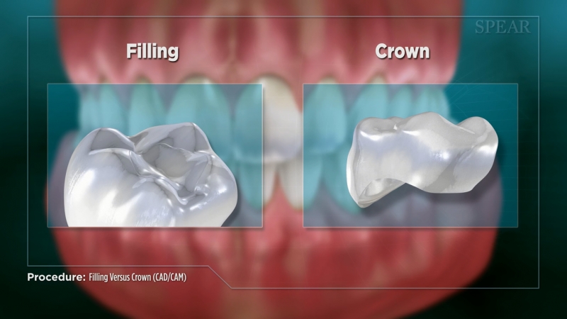 Filling Versus Crown (CAD/CAM)