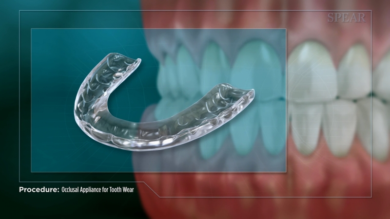 Occlusal Appliance for Tooth Wear