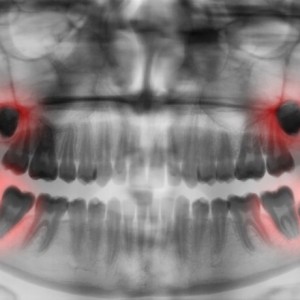 Start by getting an assessment of your wisdom teeth