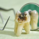 Risk assessment for cavities