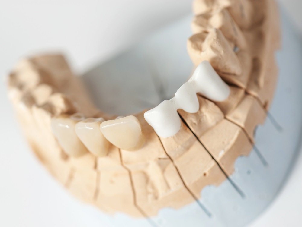Dental implant technology