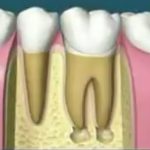 Does a root canal hurt?