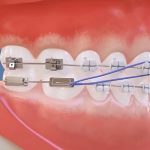 How do braces really work?