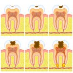 Do natural cavity remedies work?