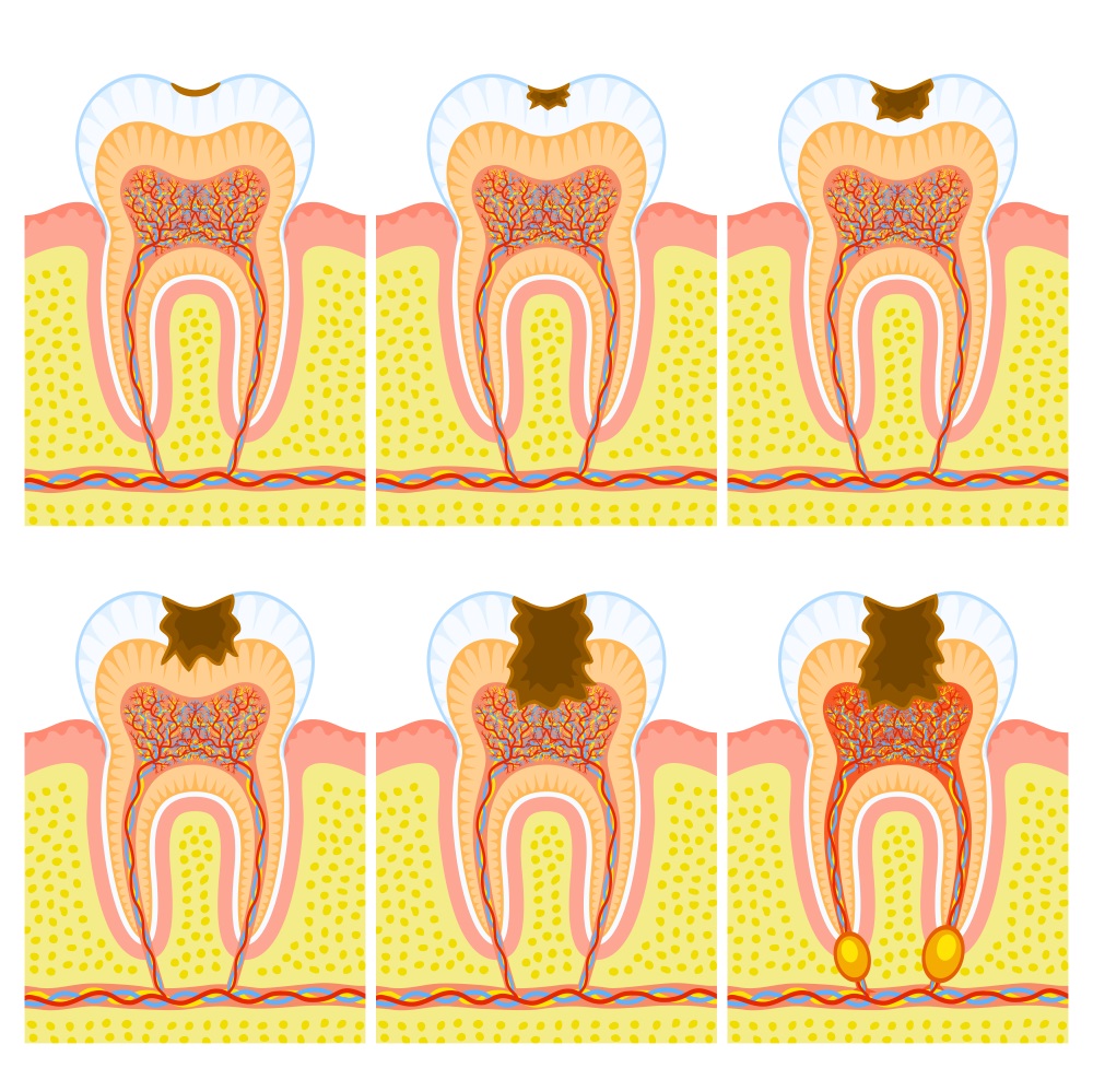 Do natural cavity remedies work?