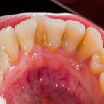 A Case of Crooked Front Teeth and Dental Malocclusion