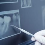 Dental X-Ray Safety FAQs