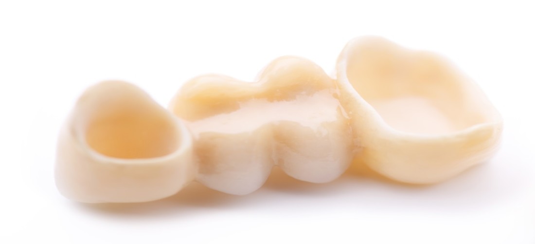 Dental Crowns and Dental Prosthetics Dental Crowns and Dental Prosthetics