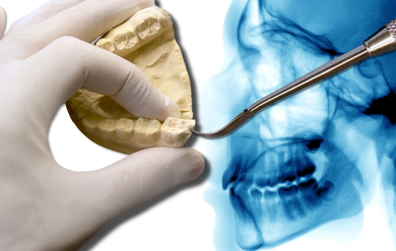Wisdom Teeth FAQ