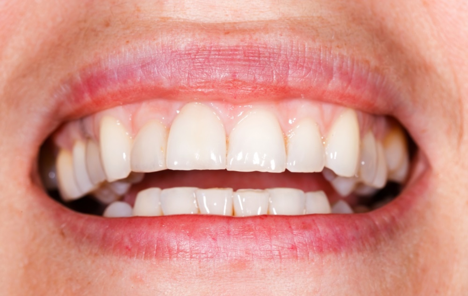 Is whitening your teeth at the dentist worth it