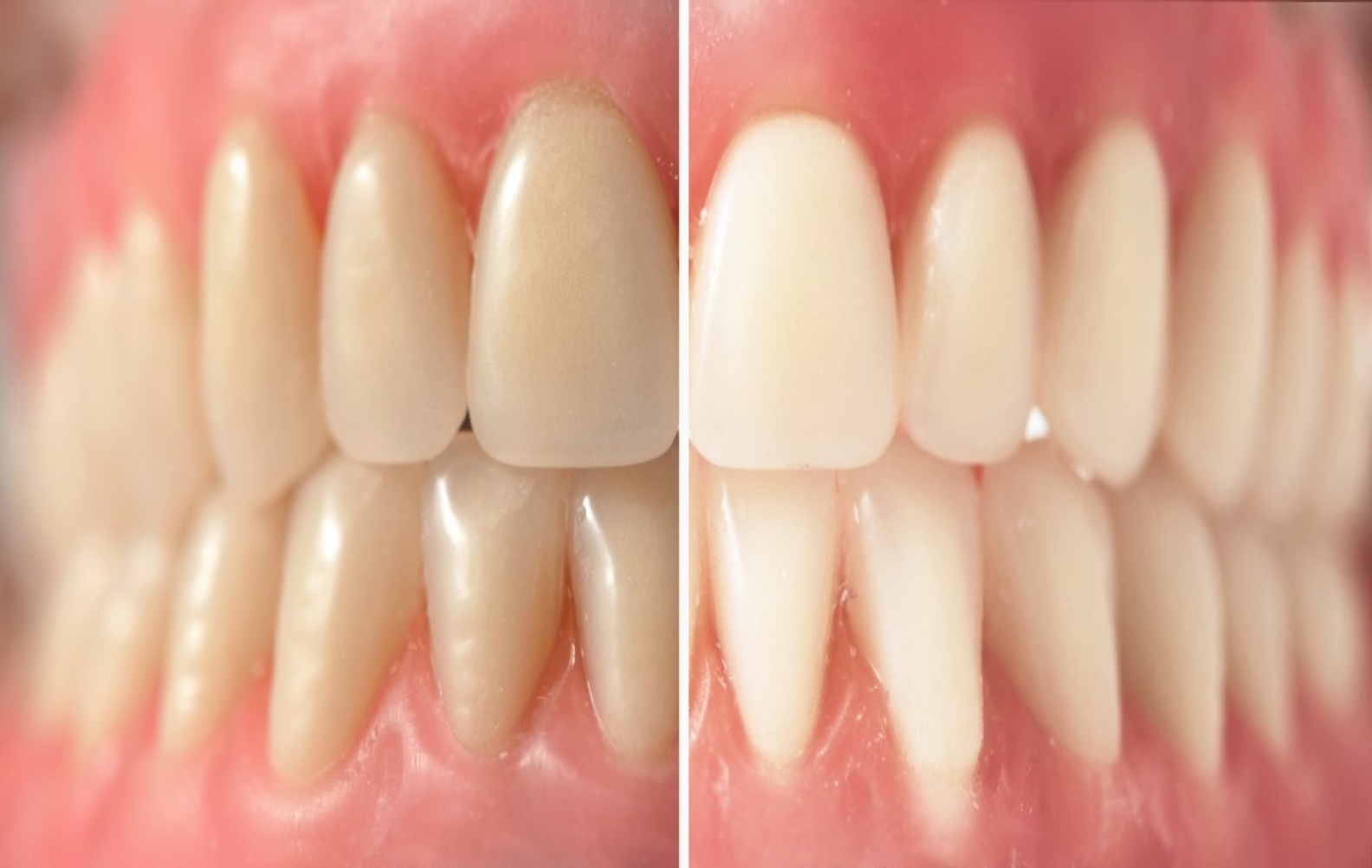 Tooth Whitening in Fort Worth Fort Worth Dentist 7th Street