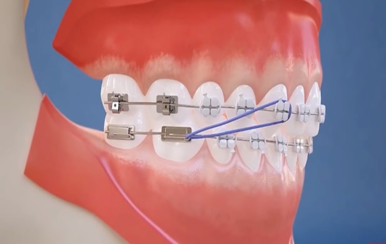 [VIDEO] How Do Braces Work? Like, Really?…