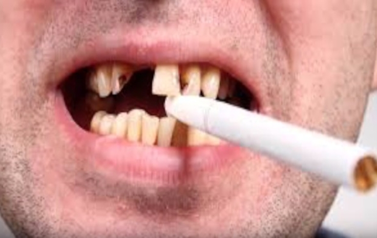 do cigarettes cause dry mouth What You Don't Want To Read, But Need To See, About Smoking And Your Mouth  | Fort Worth Dentist | 7th Street District