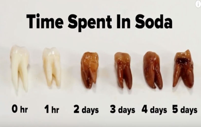 My Teeth Hurt After Drinking Soda